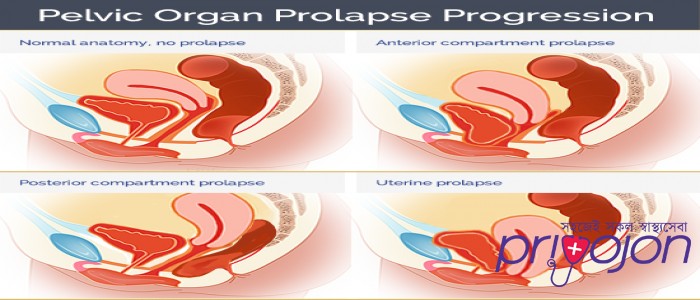 pelvic-organ-prolapse-treatment-procedure-cost-and-side-effects