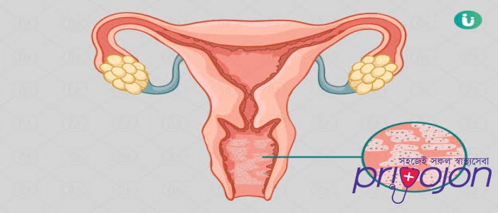 vaginal-infection-symptom-treatment-and-causes