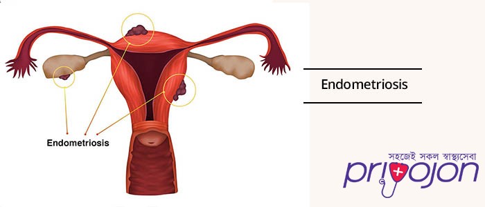 endometriosis-symptom-treatment-and-causes