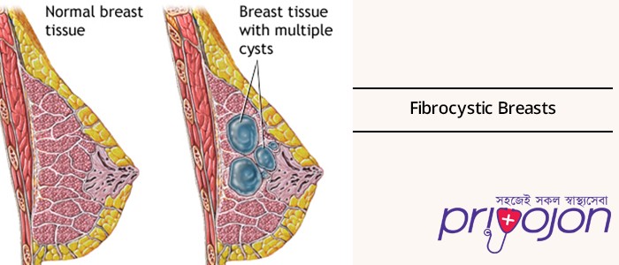 fibrocystic-breast-disease-treatment-procedure-cost-and-side-effects