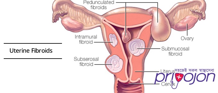 uterine-fibroids-treatment-procedure-cost-and-side-effects