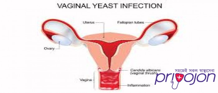 vaginal-yeast-infection