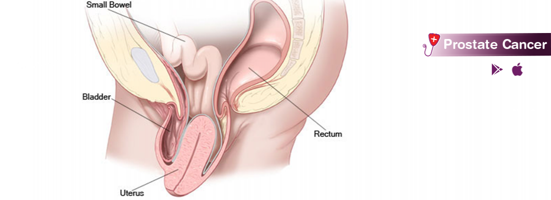 prostate-cancer