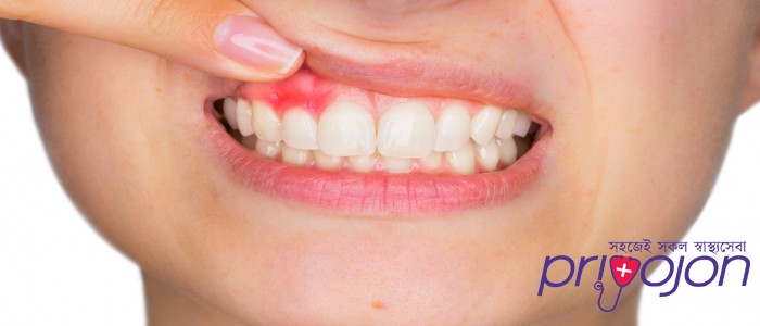 gum-disease-gingivitis-and-periodontitis