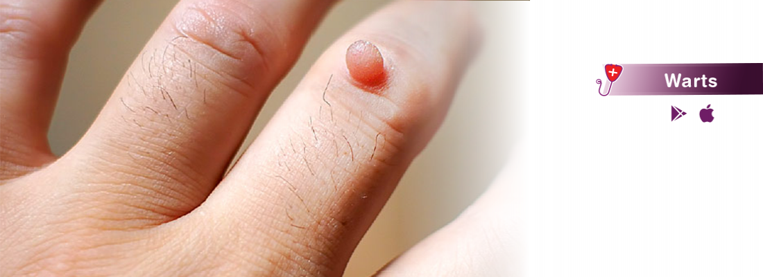 warts-causes-symptom-diagnosis-treatment-prevention-and-removal