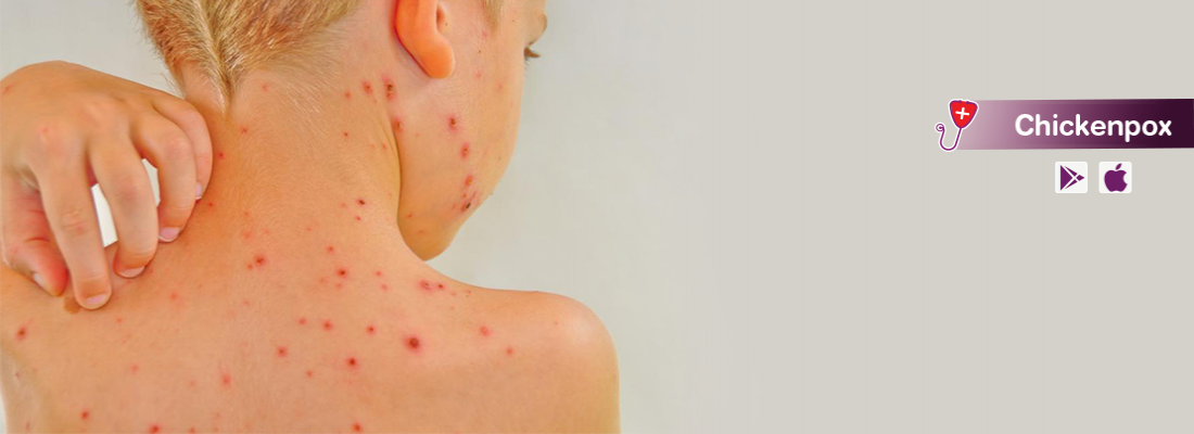 chickenpox-symptom-treatment-and-causes