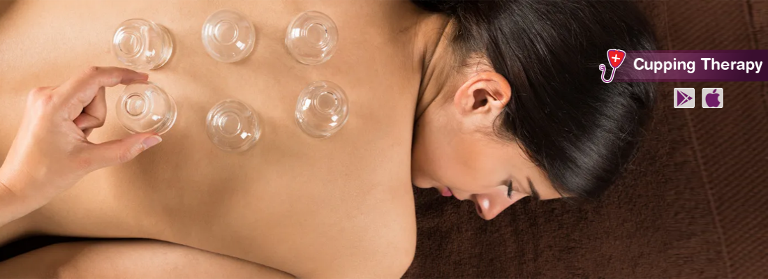 what-is-cupping-therapy-uses-benefits-side-effects-and-more