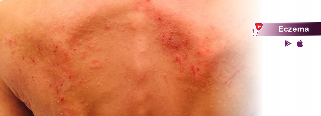 everything-you-need-to-know-about-eczema-with-symptoms-causes-treatment